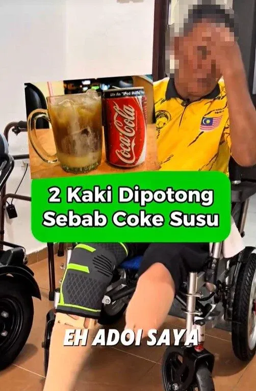 Dua Kaki Pria Ini Harus Diamputasi Akibat Sering Minum Soda Manis