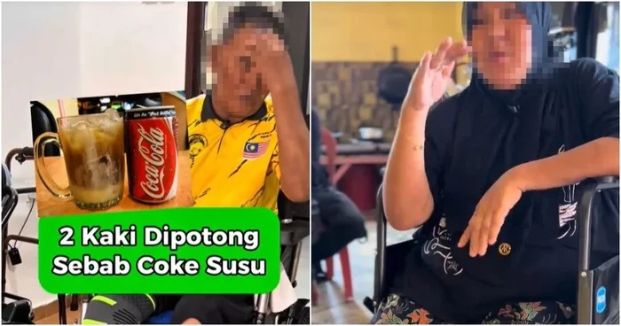 Dua Kaki Pria Ini Harus Diamputasi Akibat Sering Minum Soda Manis