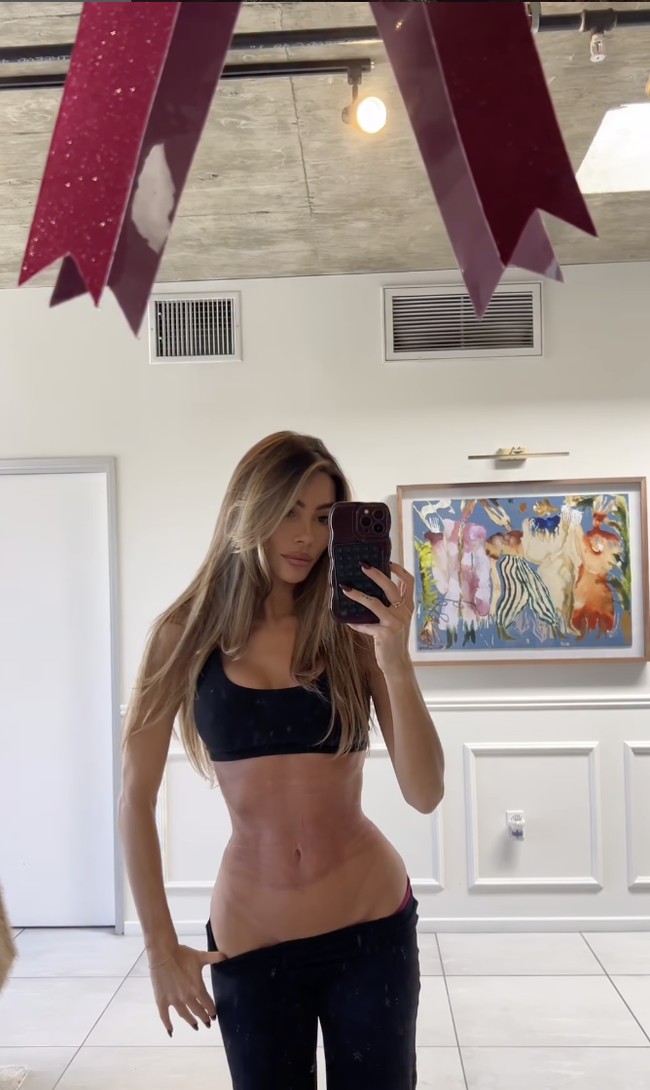 Prosedur tersebut adalah rib remodeling yang mulai populer di Amerika Serikat tahun lalu. Teknik ini diklaim mampu mengecilkan torso tanpa harus mengangkat tulang rusuk sepenuhnya, melainkan dengan menciptakan fraktur terkontrol agar bentuk rusuk berubah secara bertahap. Inilah penampilannya setelah sebulan rib modelling. Foto: dok. Instagram Enna Schell