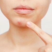 Kenapa Ada Jerawat di Dagu? Pahami Penyebab hingga Cara Mengatasinya