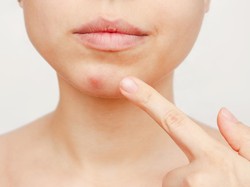 Kenapa Ada Jerawat di Dagu? Pahami Penyebab hingga Cara Mengatasinya