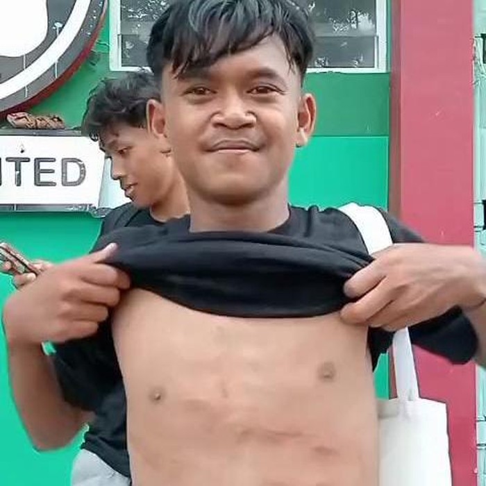 Kondisi dada Firman Nugraha, pemain Perseta Tulungagung setelah mengalami tendangan horor dari pemain Putra Jaya Pasuruan