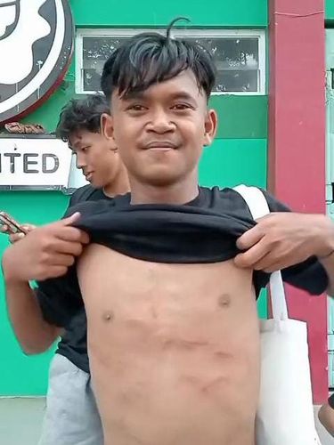 Kondisi dada Firman Nugraha, pemain Perseta Tulungagung setelah mengalami tendangan horor dari pemain Putra Jaya Pasuruan