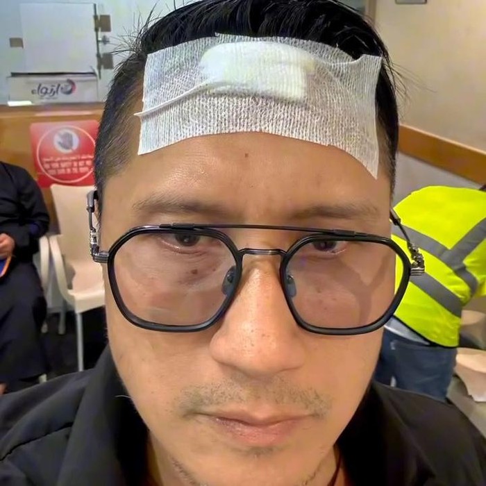 Arie Untung Alami Kepala Bocor di Arab