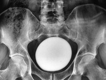 Dokter Temukan Batu Kemih Raksasa di Tubuh Pasien, Ukurannya Mirip Telur Burung Unta