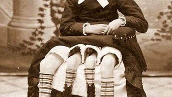 Josephine Myrtle Corbin lahir memiliki kondisi genetik langka. Di mana ia memiliki empat kaki. Ternyata ia memiliki ‘kembaran’. Tidak hanya kaki empat, kecacatan itu muncul satu persatu, mulai dari hanya ada tiga jari di setiap kakinya. Myrtle mampu mengendalikan anggota tubuh dari ‘kembarannya’. Namun tidak bisa menggerakan kaki ‘kembarannya’ untuk berjalan. Foto: Boredpanda