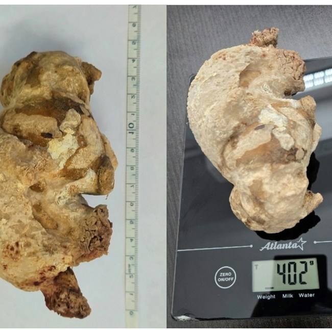 Momen Dokter Temukan Batu Ginjal Raksasa, Diangkat dari Perut Wanita Usia 55