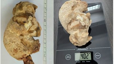 Momen Dokter Temukan Batu Ginjal Raksasa, Diangkat dari Perut Wanita Usia 55