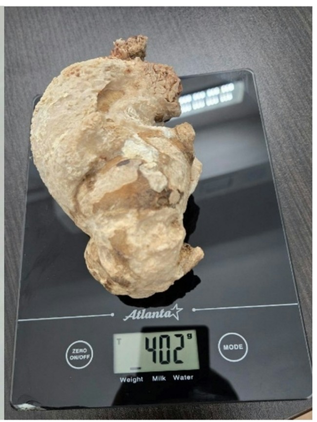 Momen Dokter Temukan Batu Ginjal Raksasa, Diangkat dari Perut Wanita Usia 55