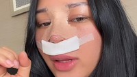 Mutia Ayu justru merasa penampilan hari kedua setelah operasi hidung berbeda banget. Muka signifikan bengkak, tulisnya. (Foto: dok Instagram mutia_ayuu)