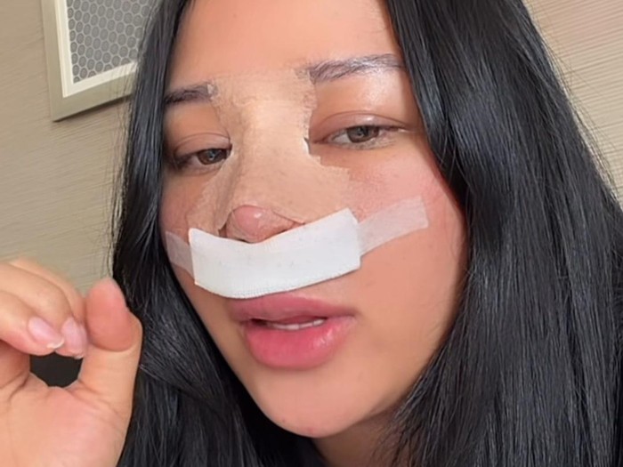 Mutia Ayu Operasi Hidung Keempat Kali, Ini Alasan Utamanya