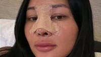Mutia Ayu juga memperlihatkan penampilannya sehari setelah operasi hidung. Baru selesai dibersihin sama aku sendiri. Wajahnya masih oke, gak begitu bengkak, tulisnya. (Foto: dok Instagram mutia_ayuu)