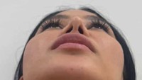 Mutia Ayu menjelaskan mengapa menjalani operasi plastik. Karena hidung aku miring kayak gini. Kedua, terlalu lancip banget. Jadi secara estetikanya gak indah banget, apalagi buat aku yang lihat setiap hari, tulisnya. (Foto: dok Instagram mutia_ayuu)