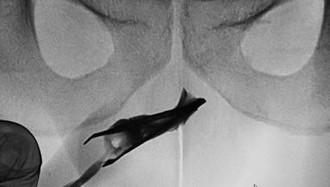 Ngilu! Momen Dokter Temukan Pinset 'Nyangkut' di Mr P Selama 4 Tahun