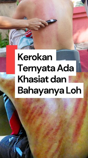 Video: Khasiat dan Efek Bahaya dari Kerokan