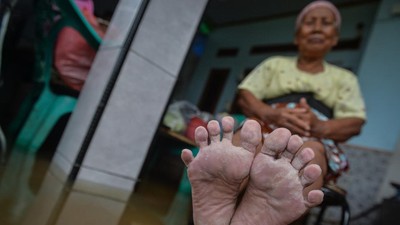 Banjir Belum Surut di Desa Pasir Ampo, Warga Mengeluh Penyakit Kulit