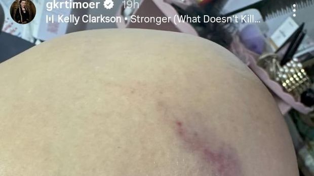 GKR Timoer tunjukkan foto luka lebam yang dialami dirinya.