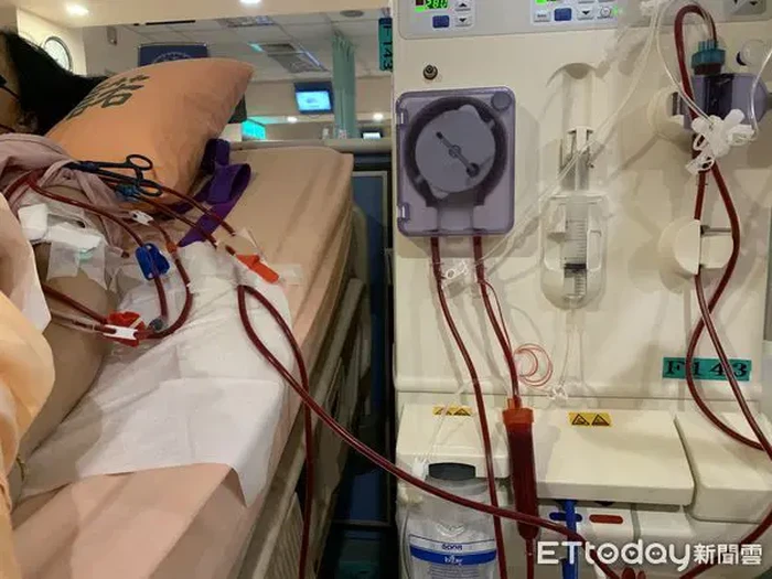 Wanita alami gagal ginjal karena minum teh boba setiap hari