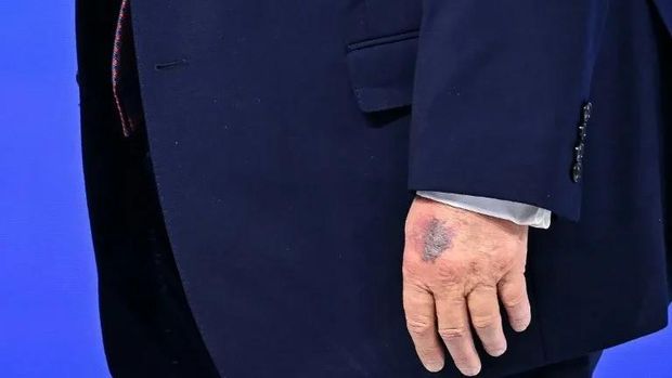 Fresh bruising could be seen on the back of US President Donald Trump's left hand during an event in Davos, Switzerland (Fabrice COFFRINI/AFP)