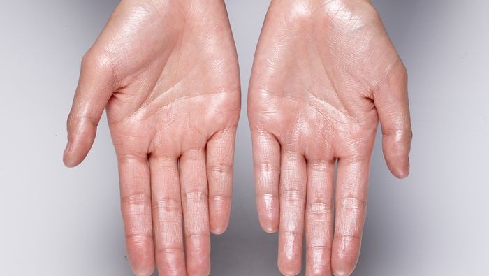 Mengapa Telapak Tangan Selalu Basah? Ini Penyebab dan Solusinya