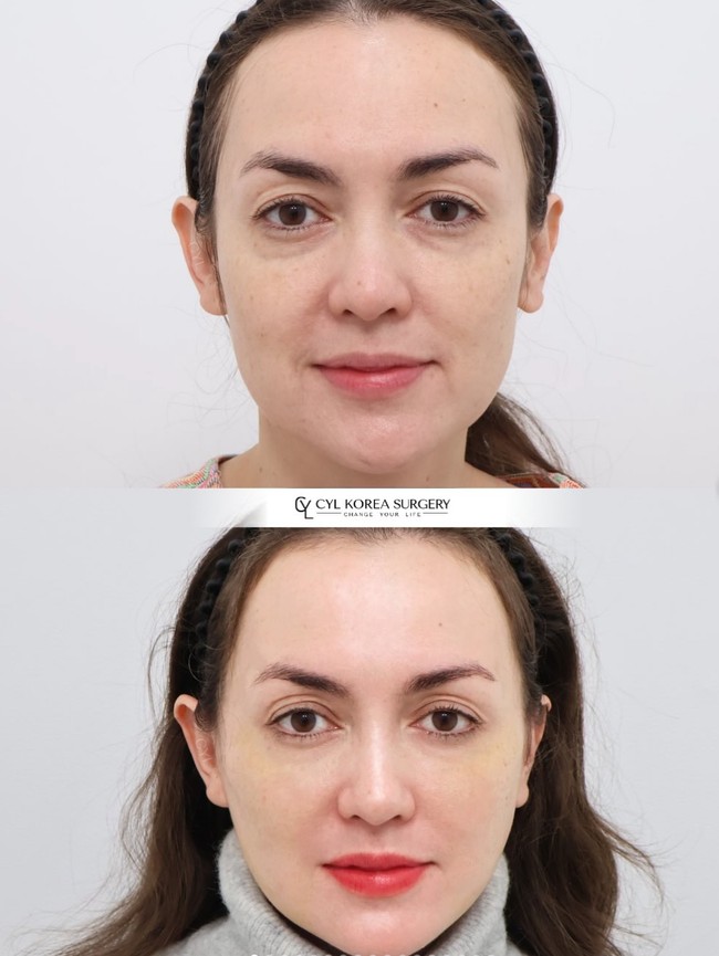 Perbedaan wajah Rianti sebelum dan setelah oplas. Kini wajahnya terlihat lebih terangkat dan bebas kerutan di usia 42 tahun. Foto: Instagram/@riantic