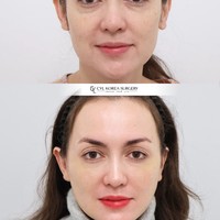 Perbedaan wajah Rianti sebelum dan setelah oplas. Kini wajahnya terlihat lebih terangkat dan bebas kerutan di usia 42 tahun. Foto: Instagram/@riantic