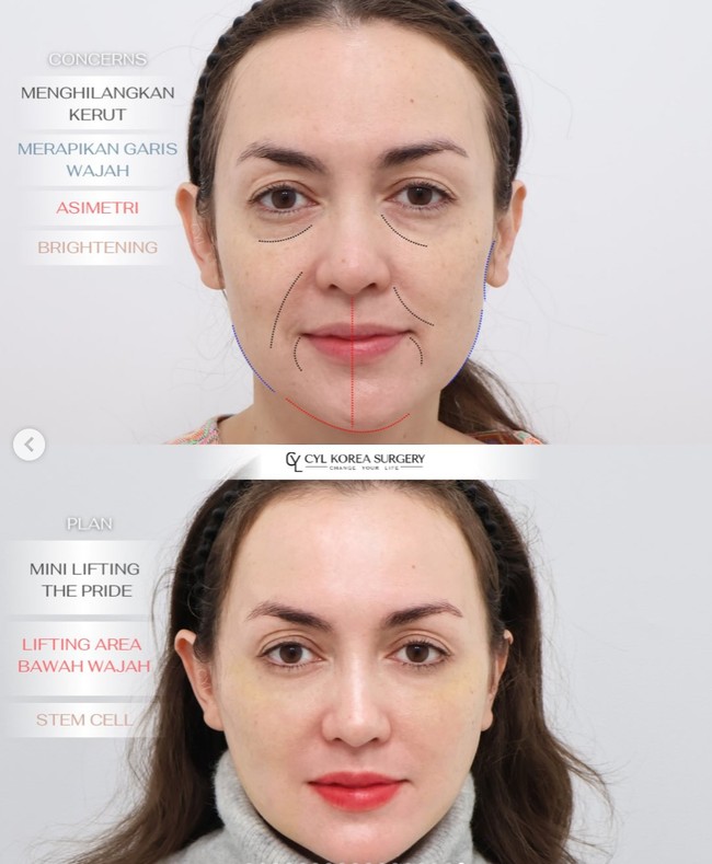 Rianti menjalani mini lifting, stem cell therapy, serta lower face lifting. Prosedur tersebut diklaim memberikan hasil perbaikan asimetri secara alami, kerutan tertata rapi tanpa terlihat berlebihan, serta warna kulit tampak lebih cerah dan sehat. Foto: Instagram/@riantic