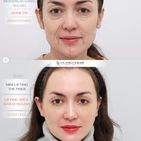 Rianti menjalani mini lifting, stem cell therapy, serta lower face lifting. Prosedur tersebut diklaim memberikan hasil perbaikan asimetri secara alami, kerutan tertata rapi tanpa terlihat berlebihan, serta warna kulit tampak lebih cerah dan sehat. Foto: Instagram/@riantic