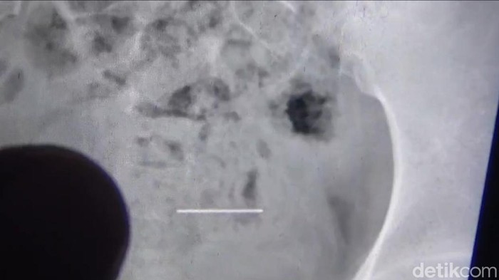 Jarum Pentul Tertelan, Remaja Sumedang Dilarikan ke RS