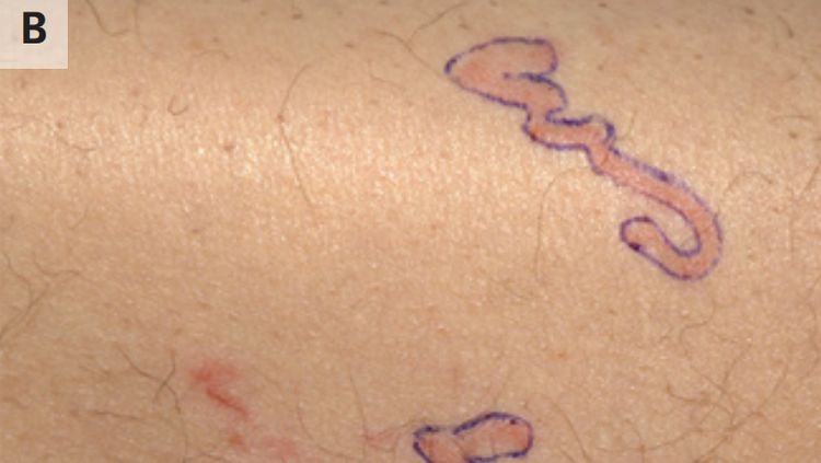 Merinding! Potret Tubuh Ruam Merah, Ternyata Ada Cacing Merayap di Bawah Kulit