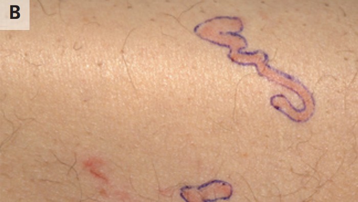 Pria Heran Ruam Kulitnya Bergerak, Rupanya Ada Cacing yang Merayap