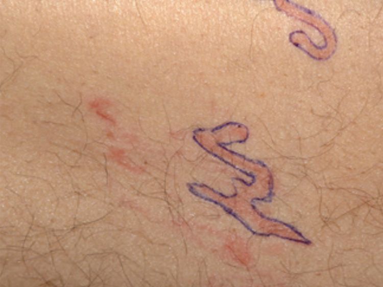Merinding! Potret Tubuh Ruam Merah, Ternyata Ada Cacing Merayap di Bawah Kulit
