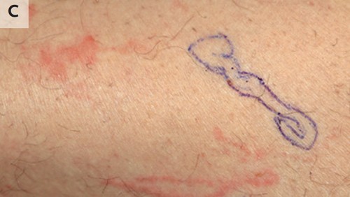 Cacing merayap di bawah kulit