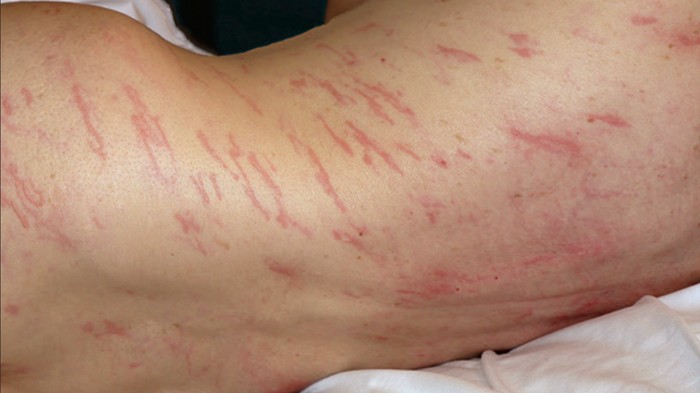 Cacing merayap di bawah kulit