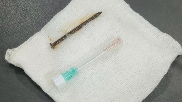 Kondisi Terkini Pria di Inhil yang Tersedak Paku 5 Cm