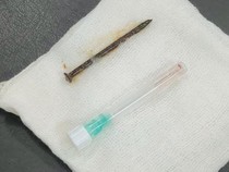 Pria 52 Tahun Tersedak Paku 5 Cm, Begini Awal Mulanya