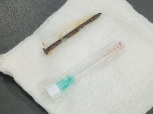 Pria 52 Tahun Tersedak Paku 5 Cm, Begini Awal Mulanya