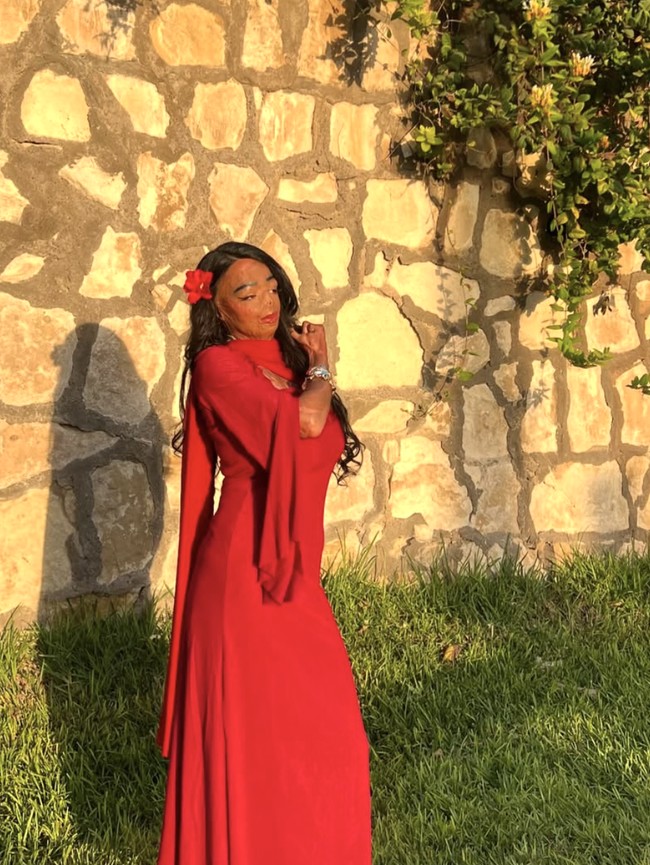 Kondisi Wanita Usai Pakai Sampo Kutu, Berjuang Percaya Diri dengan Luka Bakar