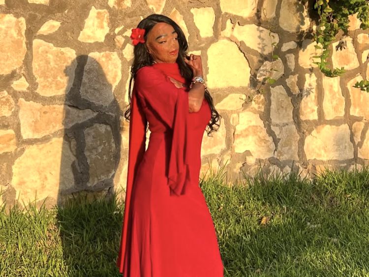 Kondisi Wanita Usai Pakai Sampo Kutu, Berjuang Percaya Diri dengan Luka Bakar