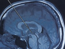 Mengenal Deep Brain Stimulation, Prosedur untuk Bantu Kendalikan Parkinson