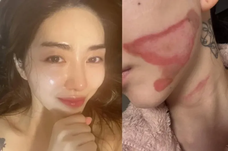 Kwon Mina Kwon Mina mengalami luka bakar setelah melakukan prosedur perawatan kulit.