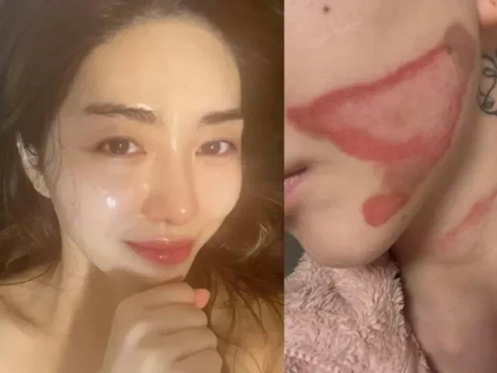 Kwon Mina mengalami luka bakar setelah melakukan prosedur perawatan kulit.