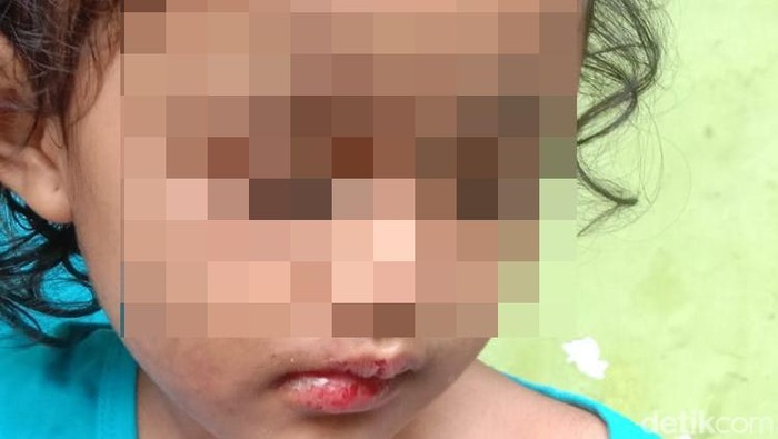 Balita korban penganiayaan oleh paman dan bibinya hingga kepalanya botak.