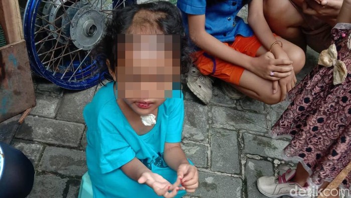 Balita korban penganiayaan oleh paman dan bibinya hingga kepalanya botak.