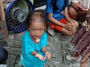 Miris! Paman dan Bibi Tega Siksa-Botaki Keponakannya yang Masih Balita