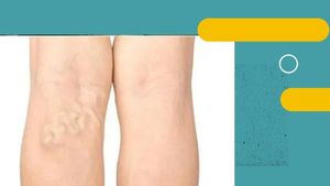 Video Benarkah Varises Bisa Sembuh dengan Salep atau Pijat?