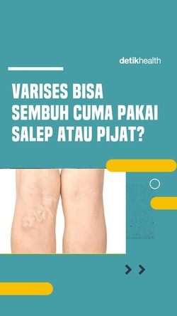 Video Benarkah Varises Bisa Sembuh dengan Salep atau Pijat?