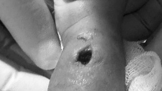 Tangan Bayi Bengkak-Berlubang Usai Diinfus, Ortu Polisikan RS di Makassar