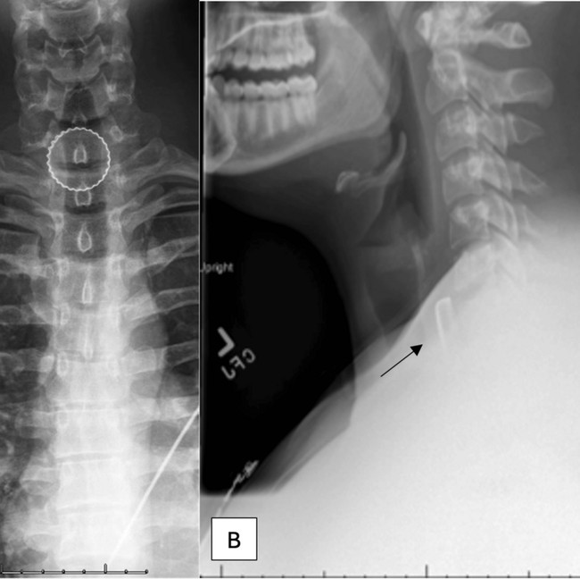 Ngilu! Penampakan Tutup Botol Nyangkut di Tenggorokan, Tak Sengaja Tertelan
