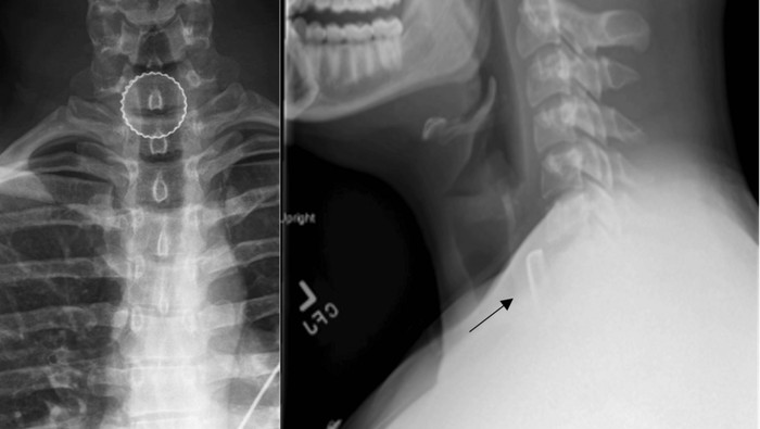 Tutup botol menyangkut di tenggorokan